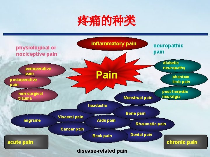 疼痛的种类 inflammatory pain physiological or nociceptive pain perioperative pain diabetic neuropathy Pain postoperative pain