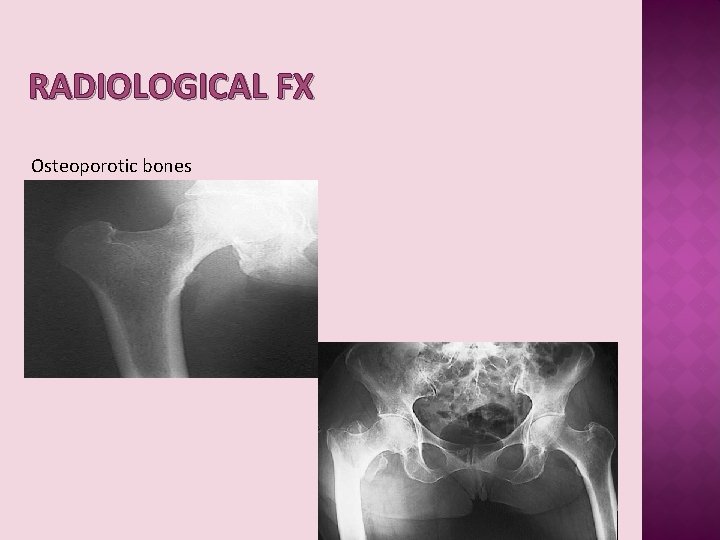 RADIOLOGICAL FX Osteoporotic bones 