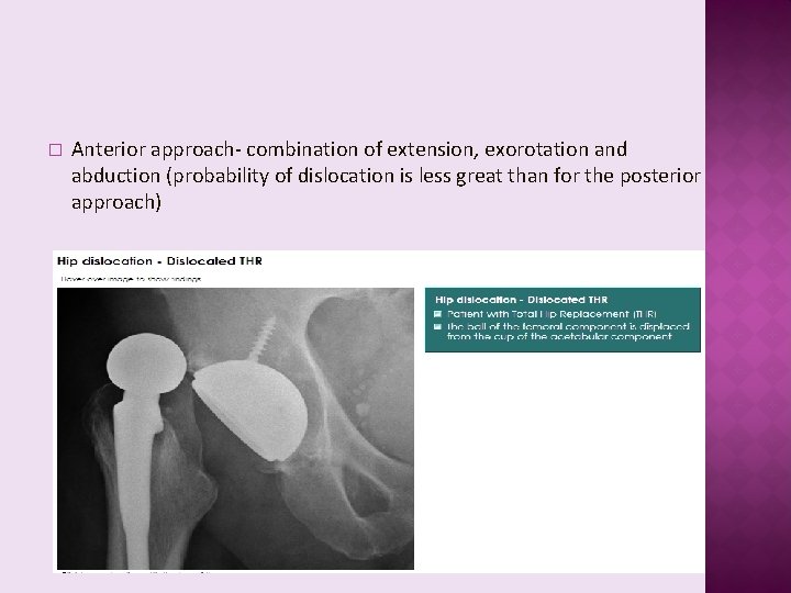 � Anterior approach- combination of extension, exorotation and abduction (probability of dislocation is less