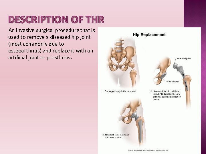 DESCRIPTION OF THR An invasive surgical procedure that is used to remove a diseased