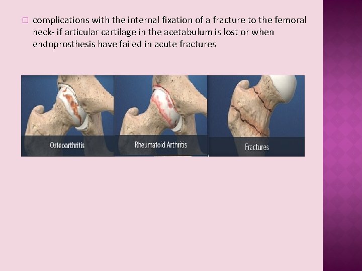 � complications with the internal fixation of a fracture to the femoral neck- if