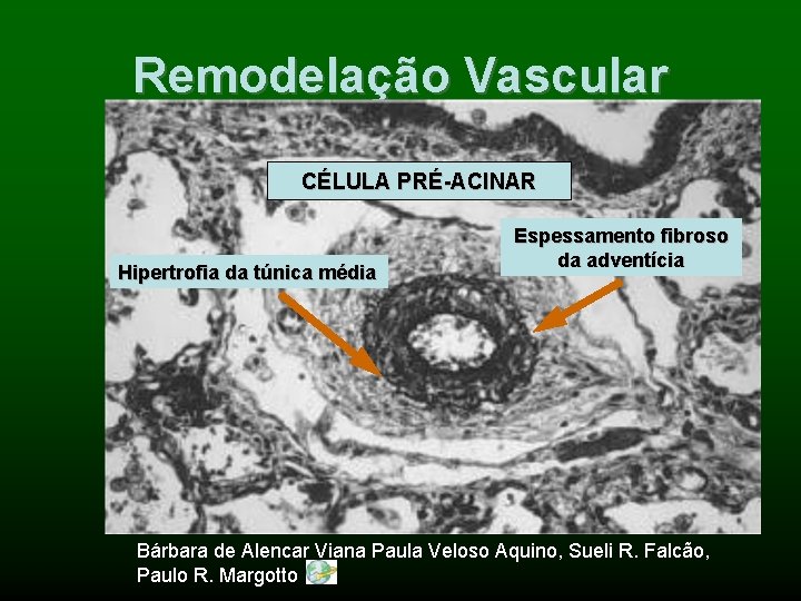 Remodelação Vascular CÉLULA PRÉ-ACINAR Hipertrofia da túnica média Espessamento fibroso da adventícia Bárbara de