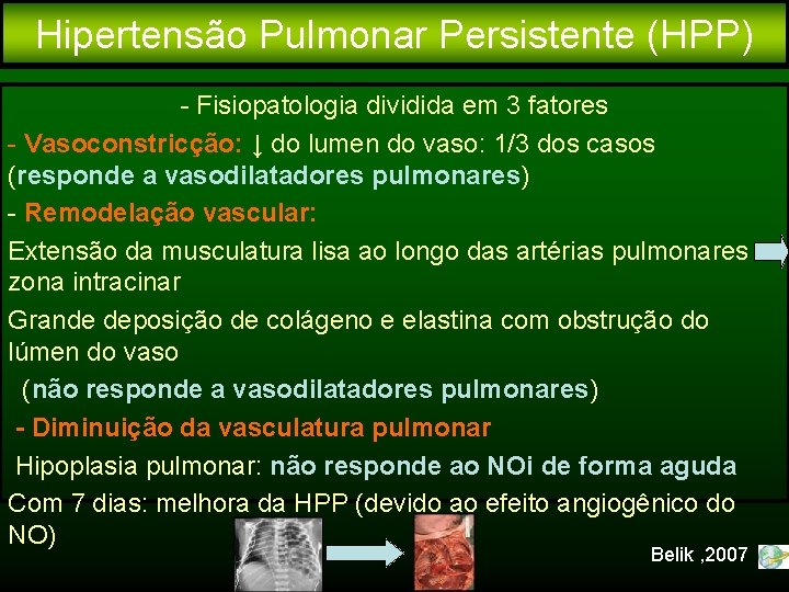 Hipertensão Pulmonar Persistente (HPP) - Fisiopatologia dividida em 3 fatores - Vasoconstricção: ↓ do