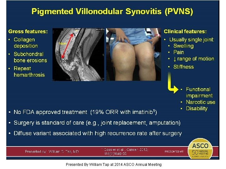 Pigmented Villonodular Synovitis (PVNS) Presented By William Tap at 2014 ASCO Annual Meeting 