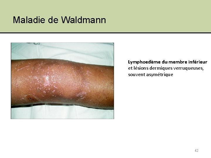 Maladie de Waldmann Lymphoedème du membre inférieur et lésions dermiques verruqueuses, souvent asymétrique 42