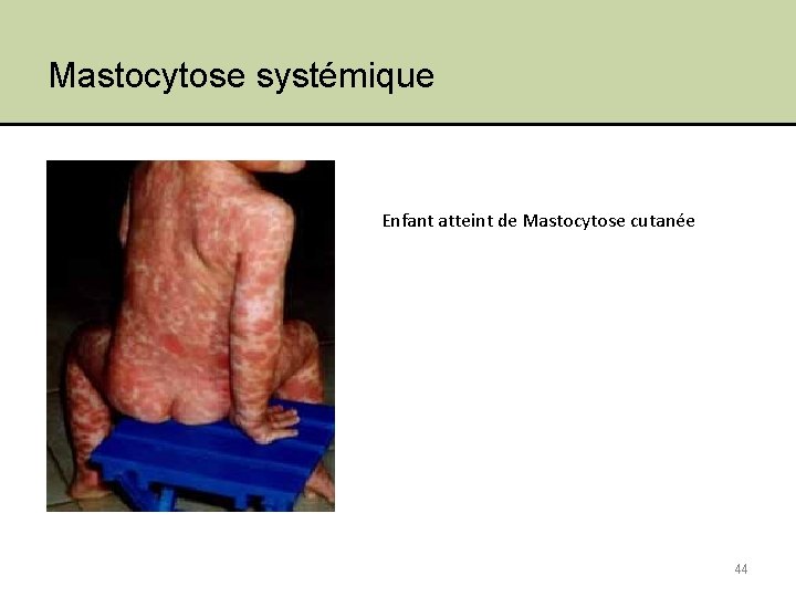Mastocytose systémique Enfant atteint de Mastocytose cutanée 44 