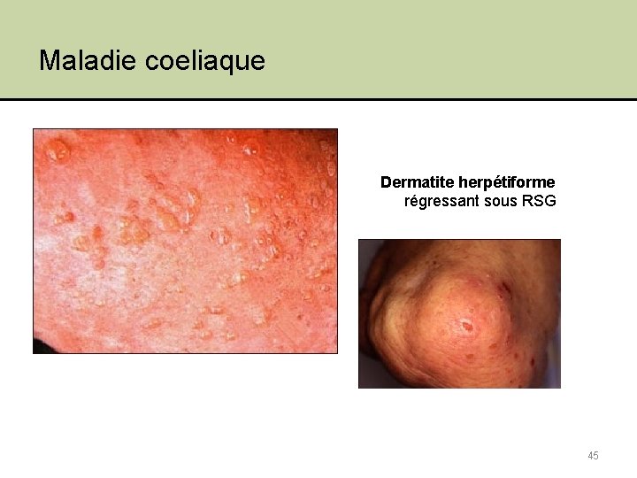 Maladie coeliaque Dermatite herpétiforme régressant sous RSG 45 