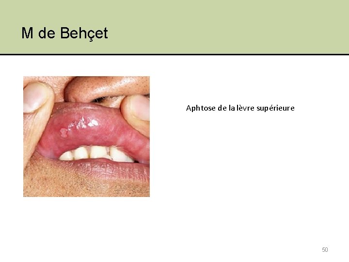 M de Behçet Aphtose de la lèvre supérieure 50 