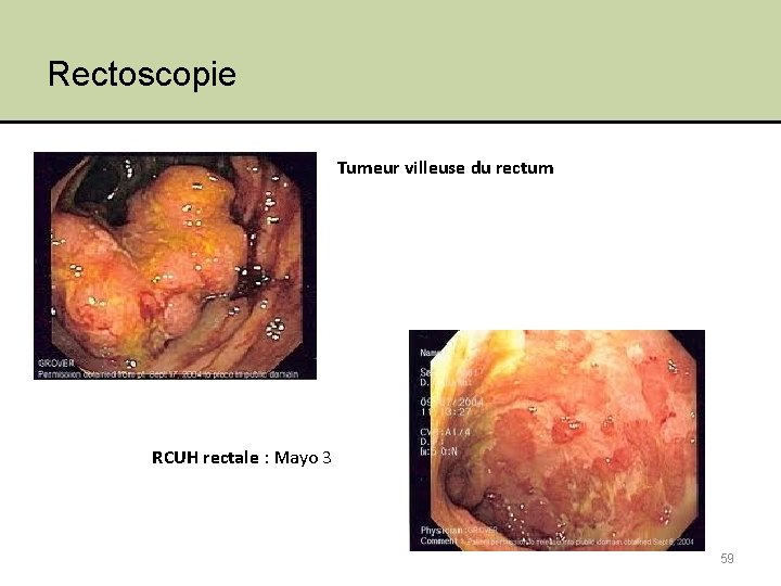 Rectoscopie Tumeur villeuse du rectum RCUH rectale : Mayo 3 59 
