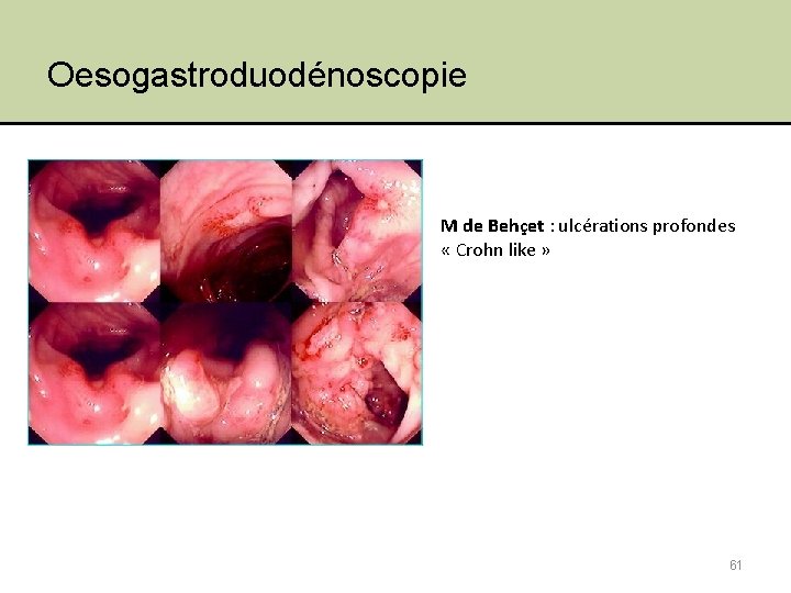 Oesogastroduodénoscopie M de Behçet : ulcérations profondes « Crohn like » 61 