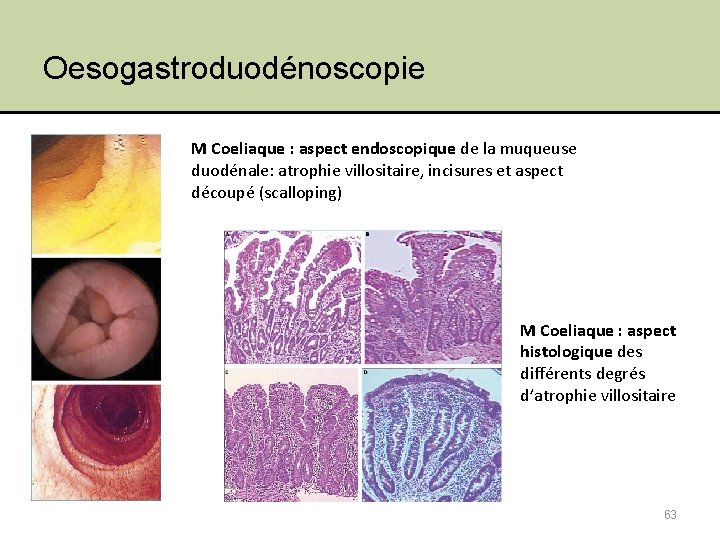 Oesogastroduodénoscopie M Coeliaque : aspect endoscopique de la muqueuse duodénale: atrophie villositaire, incisures et