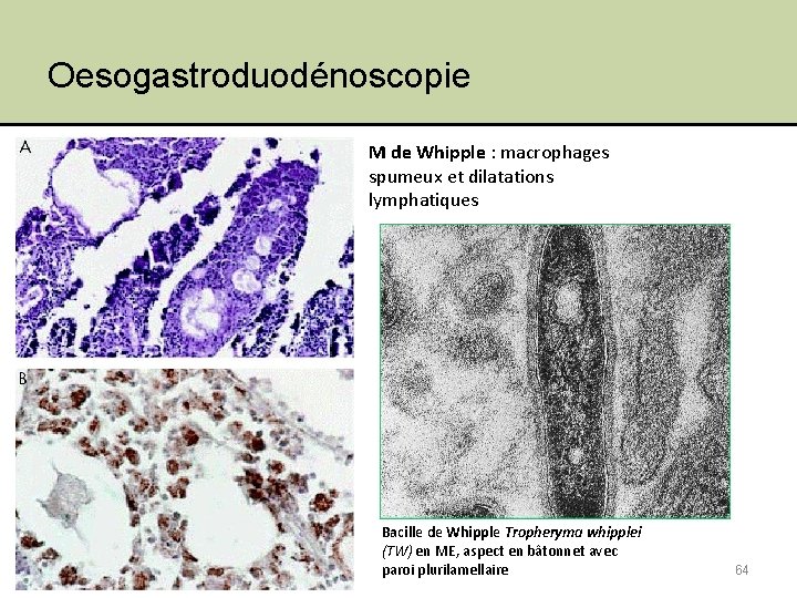 Oesogastroduodénoscopie M de Whipple : macrophages spumeux et dilatations lymphatiques Jeudi 10 février 2011
