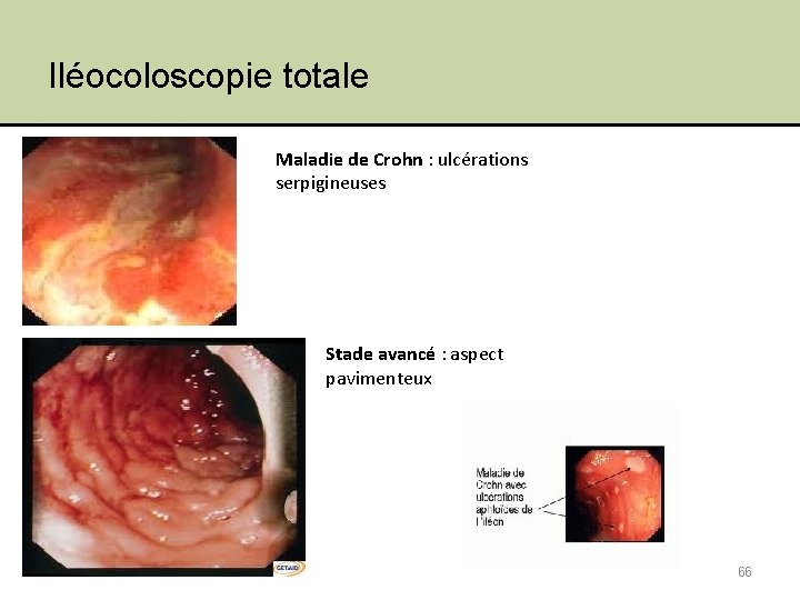 Iléocoloscopie totale Maladie de Crohn : ulcérations serpigineuses Stade avancé : aspect pavimenteux 66