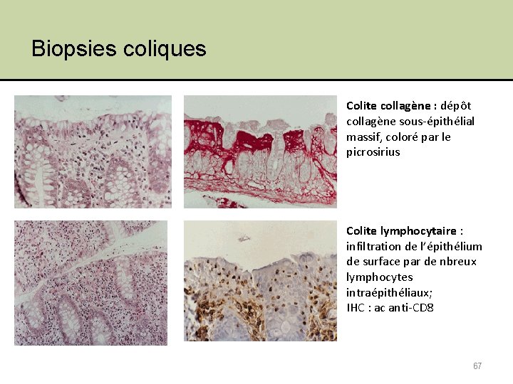 Biopsies coliques Colite collagène : dépôt collagène sous-épithélial massif, coloré par le picrosirius Colite