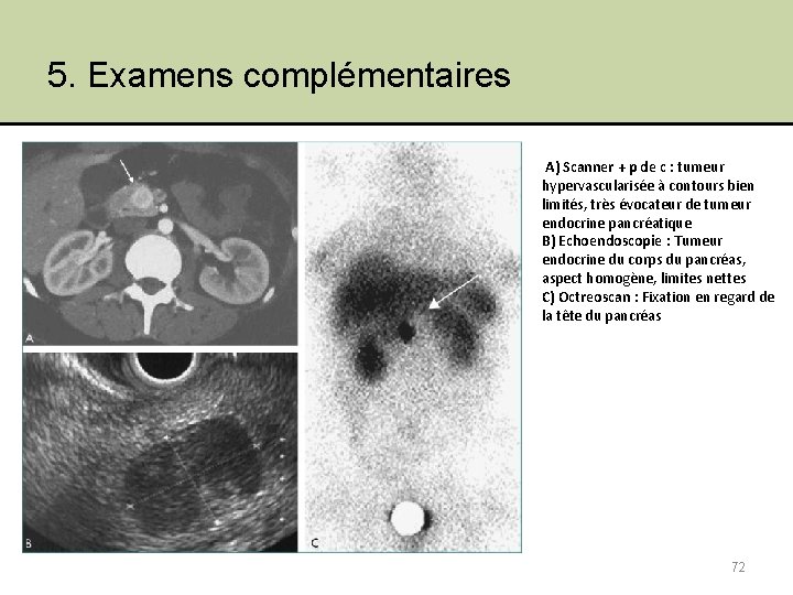 5. Examens complémentaires A) Scanner + p de c : tumeur hypervascularisée à contours