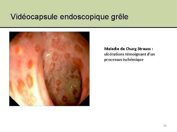 Vidéocapsule endoscopique grêle Maladie de Churg Strauss : ulcérations témoignant d’un processus ischémique 74