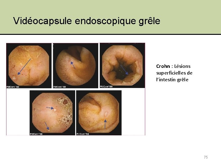 Vidéocapsule endoscopique grêle Crohn : Lésions superficielles de l’intestin grêle 75 