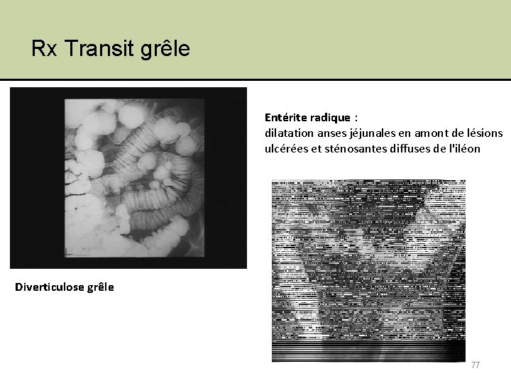 Rx Transit grêle Entérite radique : dilatation anses jéjunales en amont de lésions ulcérées