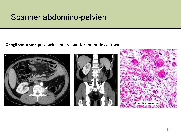 Scanner abdomino-pelvien Ganglioneurome pararachidien prenant fortement le contraste 81 