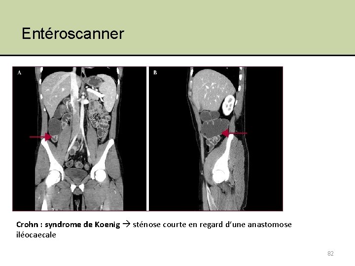 Entéroscanner Crohn : syndrome de Koenig sténose courte en regard d’une anastomose iléocaecale 82