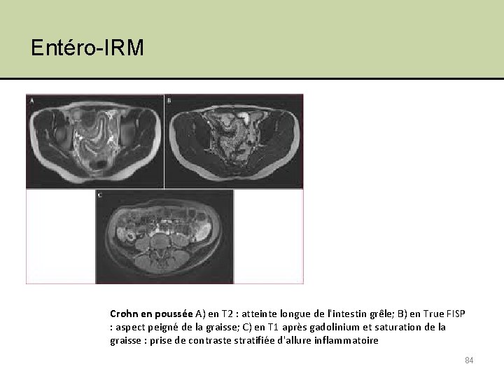 Entéro-IRM Crohn en poussée A) en T 2 : atteinte longue de l'intestin grêle;