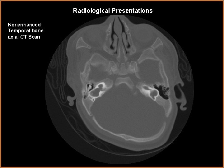 Radiological Presentations Nonenhanced Temporal bone axial CT Scan 