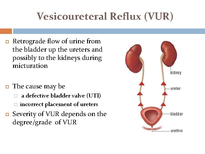 Vesicoureteral Reflux (VUR) Retrograde flow of urine from the bladder up the ureters and