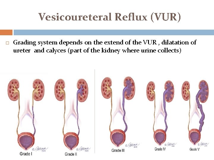 Vesicoureteral Reflux (VUR) Grading system depends on the extend of the VUR , dilatation