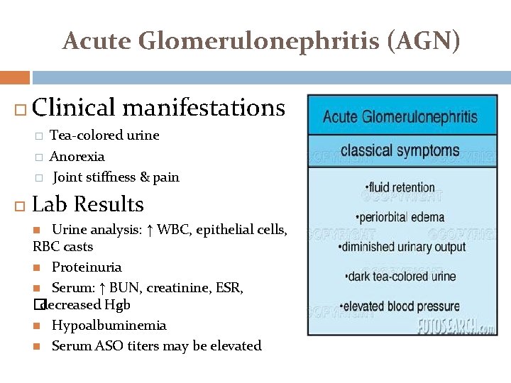 Acute Glomerulonephritis (AGN) Clinical manifestations � � � Tea-colored urine Anorexia Joint stiffness &