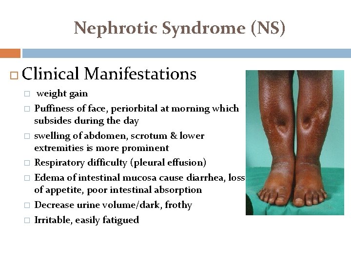 Nephrotic Syndrome (NS) Clinical Manifestations � � � � weight gain Puffiness of face,