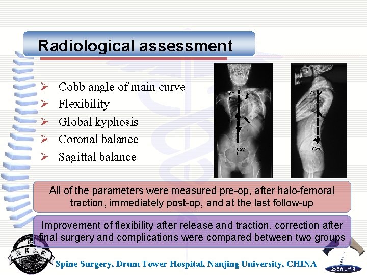 Radiological assessment Ø Ø Ø Cobb angle of main curve Flexibility Global kyphosis Coronal