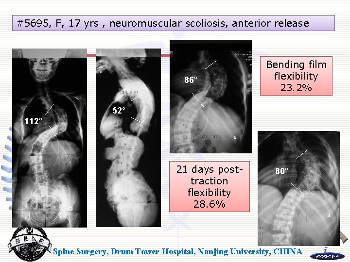 #5695, F, 17 yrs , neuromuscular scoliosis, anterior release 86° Bending film flexibility 23.