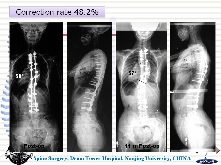 Correction rate 48. 2% 57° 58° Post-op 11 m Post-op Spine Surgery, Drum Tower