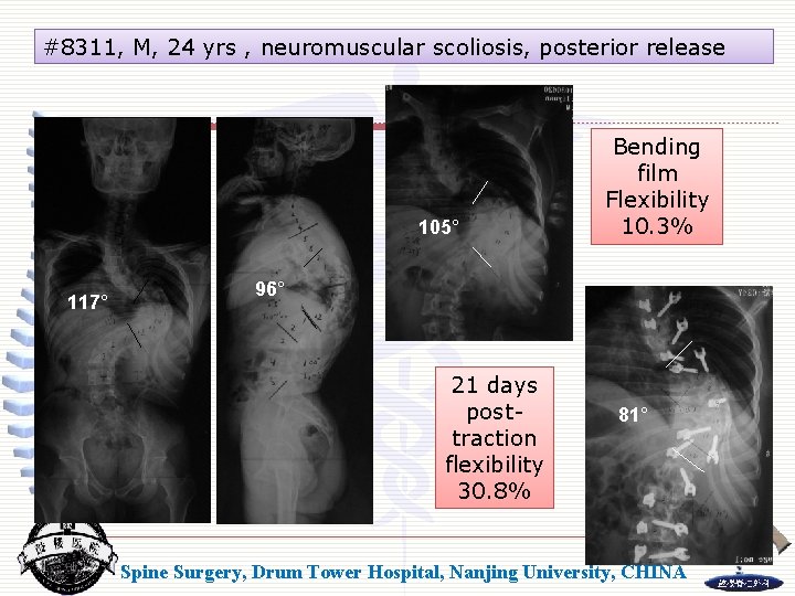 #8311, M, 24 yrs , neuromuscular scoliosis, posterior release 105° 117° Bending film Flexibility