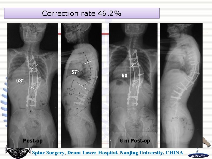 Correction rate 46. 2% 57° 63° Post-op 68° 6 m Post-op Spine Surgery, Drum