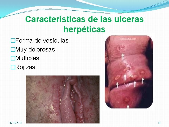 Características de las ulceras herpéticas �Forma de vesículas �Muy dolorosas �Multiples �Rojizas 16/10/2021 18