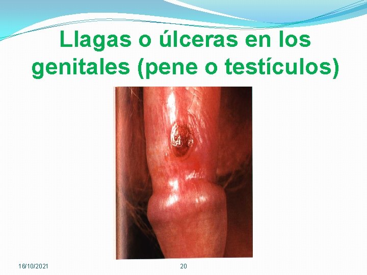 Llagas o úlceras en los genitales (pene o testículos) 16/10/2021 20 