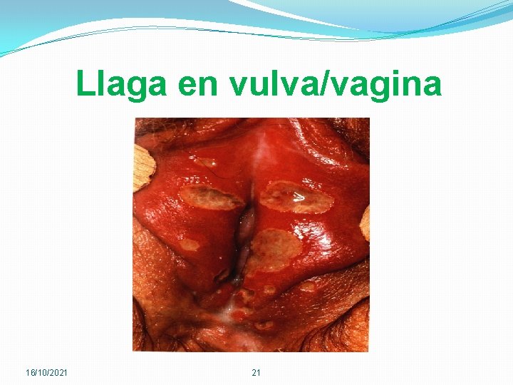 Llaga en vulva/vagina 16/10/2021 21 
