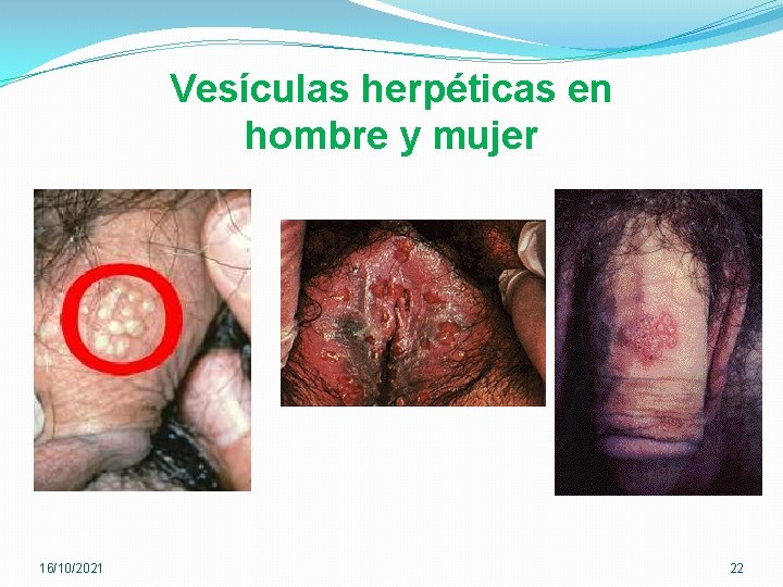 Vesículas herpéticas en hombre y mujer 16/10/2021 22 