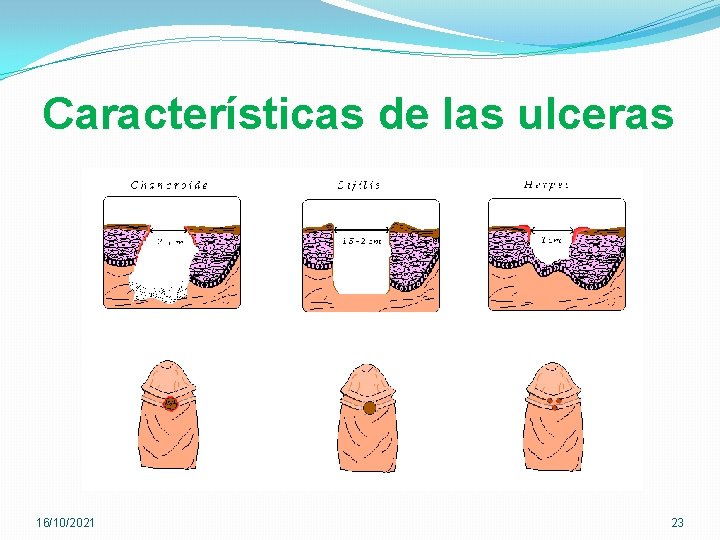 Características de las ulceras 16/10/2021 23 