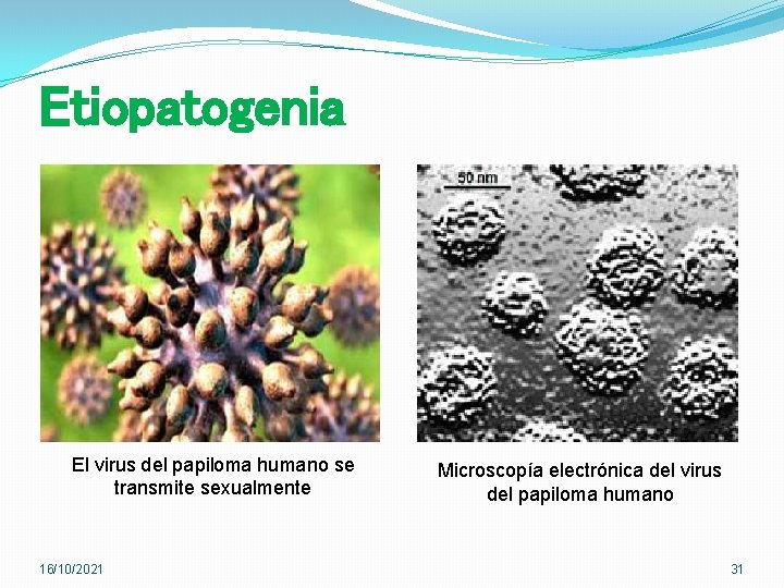 Etiopatogenia El virus del papiloma humano se transmite sexualmente 16/10/2021 Microscopía electrónica del virus