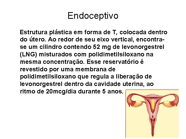 Endoceptivo Estrutura plástica em forma de T, colocada dentro do útero. Ao redor de