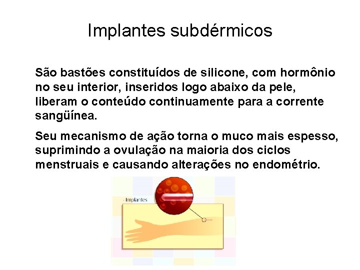 Implantes subdérmicos São bastões constituídos de silicone, com hormônio no seu interior, inseridos logo