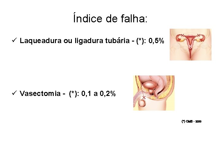 Índice de falha: ü Laqueadura ou ligadura tubária - (*): 0, 5% ü Vasectomia