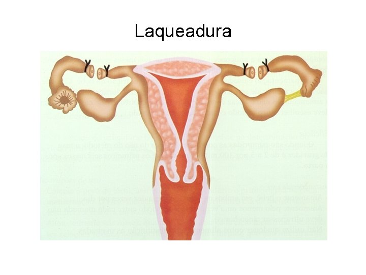 Laqueadura 