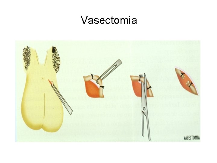 Vasectomia 