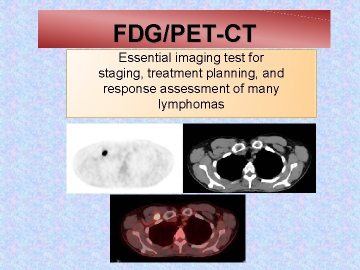 FDG/PET-CT Essential imaging test for staging, treatment planning, and response assessment of many lymphomas