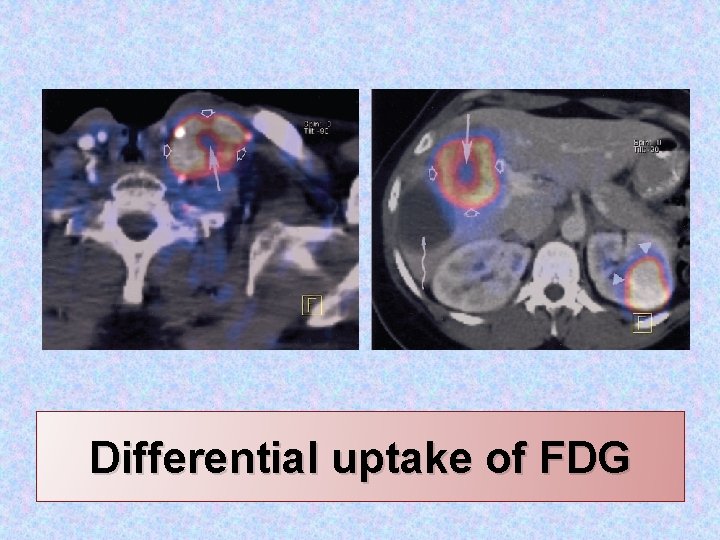 Differential uptake of FDG 