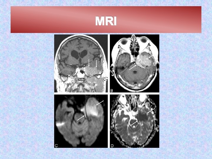 MRI 