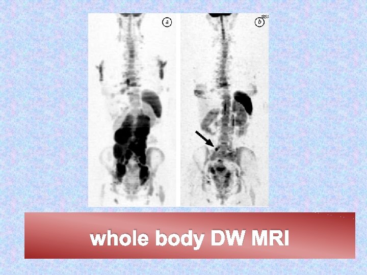 whole body DW MRI 